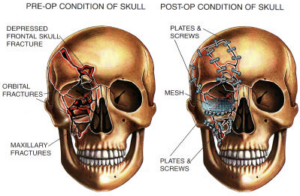 Rendering of injuries from a Joye Law Firm client after an overloaded tractor-trailer accident