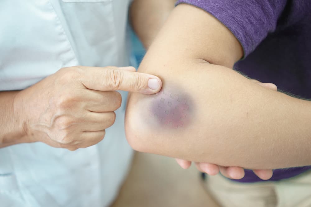 The patient has a bruise on their arm as the doctor examines it.